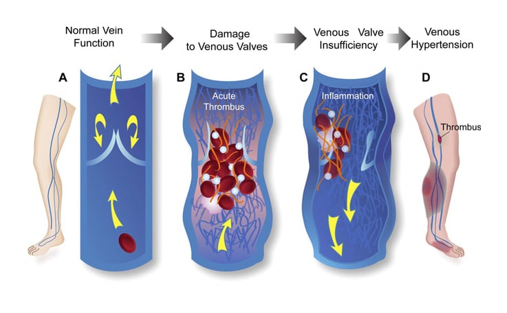 causes of vein disease